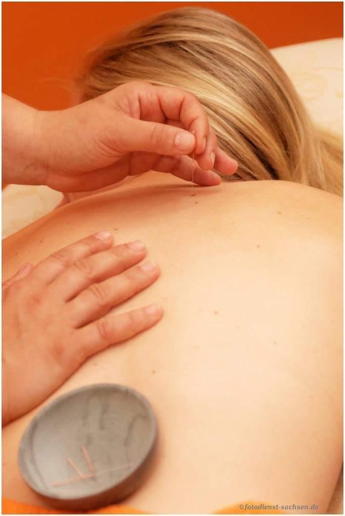 Hand mit Akupunkturnadel auf dem Ruecken einer Frau