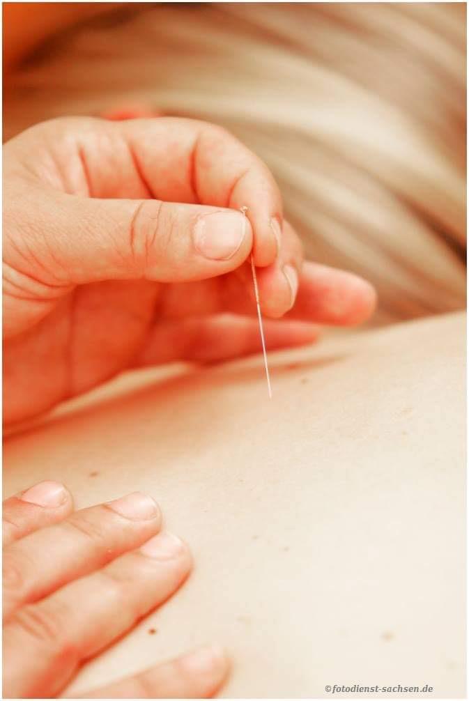 Hand, die eine Akupunkturnadel haelt